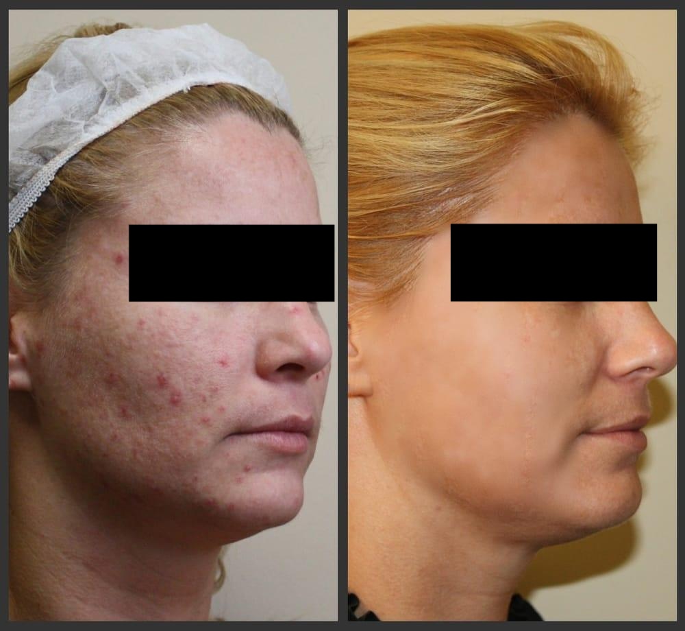 Active Acne And Acne Scar Management - Before