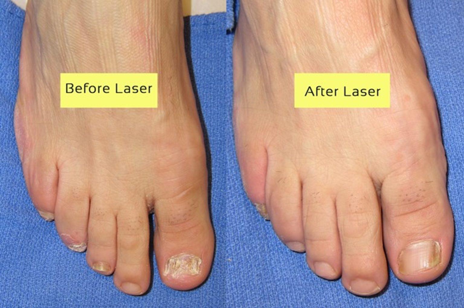 Onychomycosis Treatment