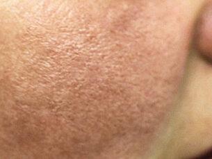 Rosacea Treatment - After