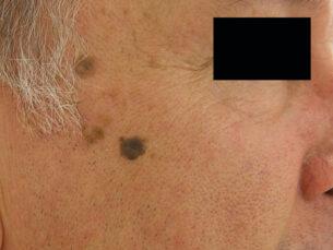 Seborrheic Keratosis Removal - Before