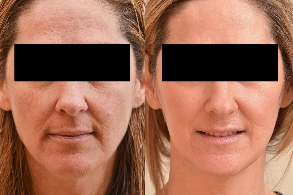 Skin Rejuvenation and Scar Reduction