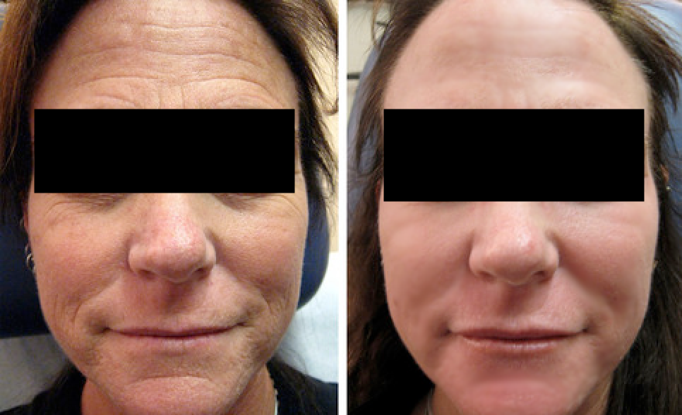 Skin Rejuvenation and Scar Reduction