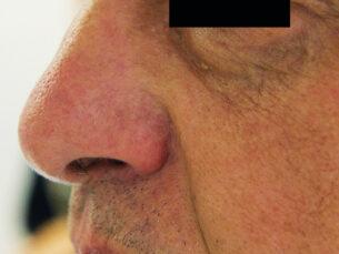 Telangiectasia Correction - After