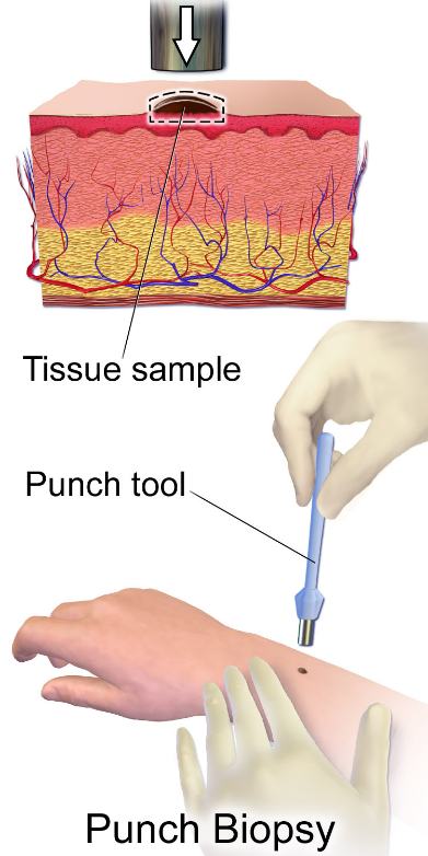 Punch Biopsy