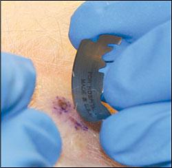 Shave Biopsy