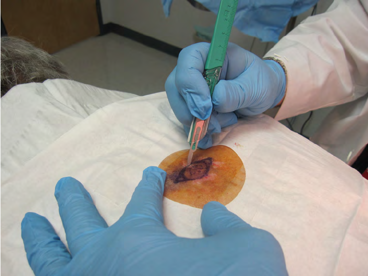 An Excision Biopsy