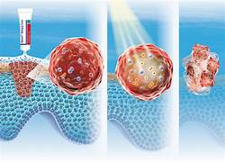 Photodynamic Therapy (PDT)